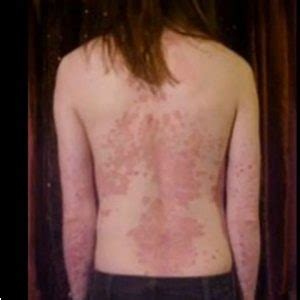 In the early stage, a worker may experience fever, chills, muscle aches, headaches, nausea, vomiting, and shortness of breath, rapid there is no specific vaccine, treatment or cure for hantavirus infection but early recognition and medical care in an intensive care unit can help with recovery. Symptoms of HIV infection