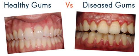 Gum Disease Treatment Mascot Dental Turrella Top Smile Clinic