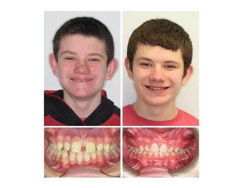 Before And After Orthodontist Rye Brook Ny Okun Orthodontics