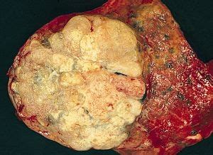 Printre investigatiile imagistice care pot ajuta la diagnosticare pancreatitei se numara: Qual è il tasso di sopravvivenza dei pazienti affetti da ...