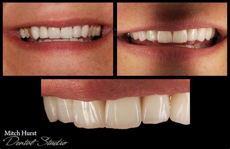 Smile Makeover Before And After Dental Cosmetic Beautiful