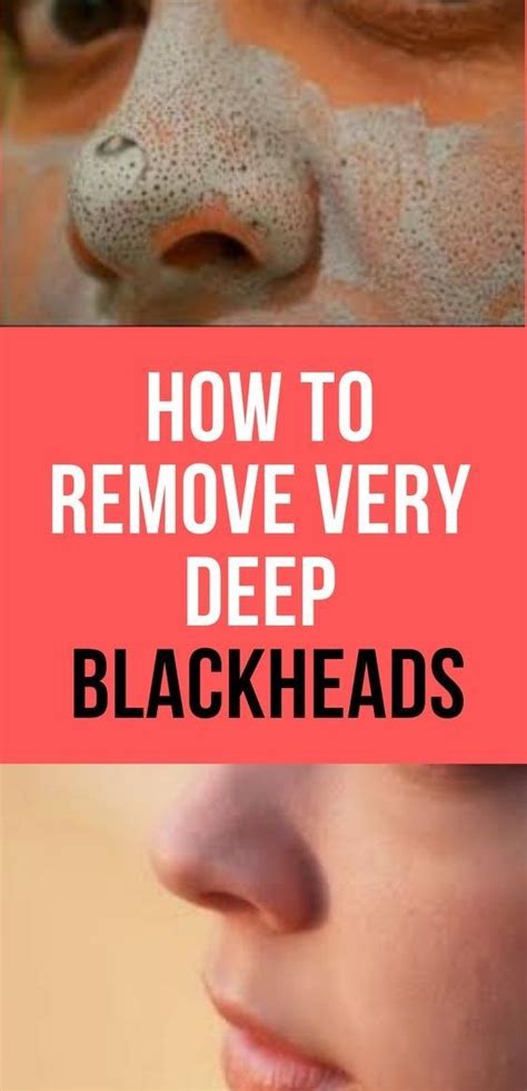 How To Get Rid Of Blackheads And Prevent Future Ones From Forming In