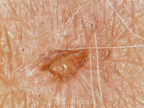 Skin Fiber Protruding From Lesion On Curezone Image Gallery