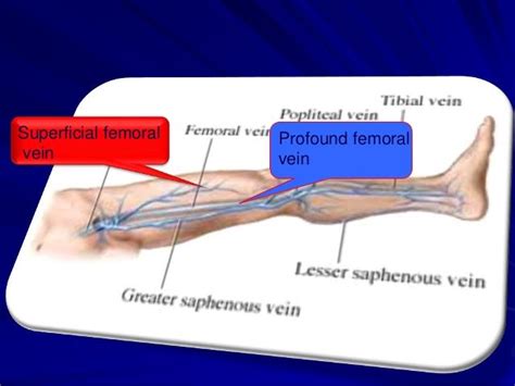 Superficial Femoral Vein Thrombosis