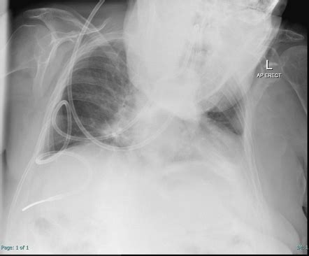 Misplaced Nasogastric Tube Resulting In Pneumothorax Radiology Case