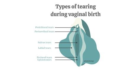 Different Types Of Tearing That May Occur During Childbirth — Lady Bird Pt
