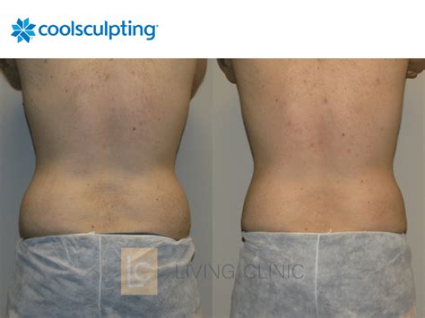 Male Flanks Coolsculpting Cryolipolysis Results Living Clinic