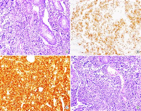 Histopathologic Findins Of Mucosa Associated Lymphoid Tissue Lymphoma