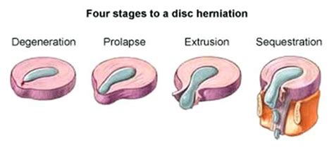 Four Stages To A Disc Herniation Degeneration Prolapse Extrusion