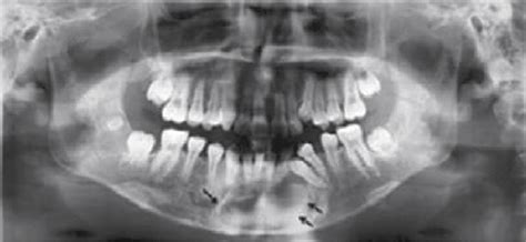 Initial Panoramic Radiograph Shows A Well Defined Radiolucent Lesion