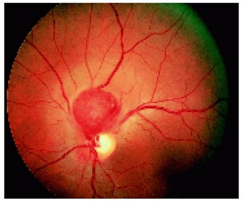 Vascular Tumors Of The Retina And Optic Disc Ento Key