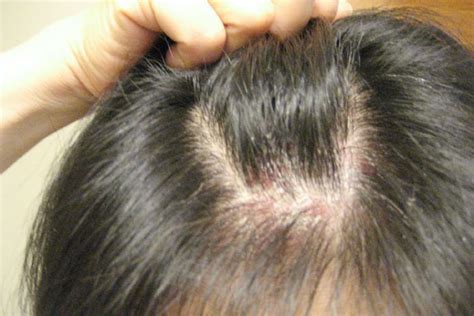 A Detailed Guide To Understanding And Treating Scalp Scabs