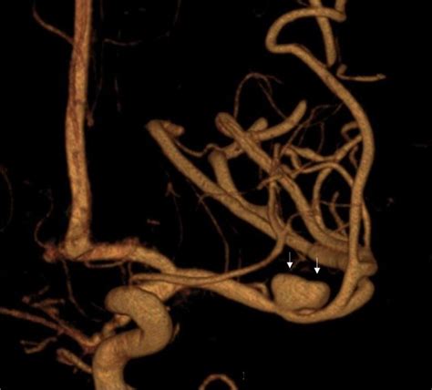 3d Digital Subtraction Angiography Shows An Increase In The Size Of