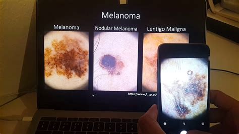 Melanoma Diagnosis Application Test Youtube