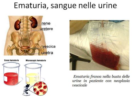 Sanguinamento Vescicale Cause Claudia Martinelli