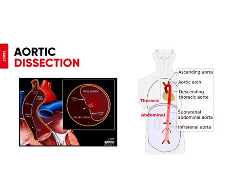 Aortic Dissection Symptoms