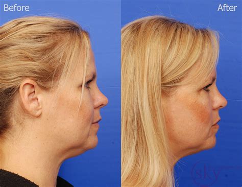 Kybella In San Diego Non Surgical Double Chin Reduction — Sky Facial