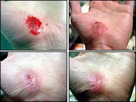 Moist Wound Healing Versus Dry Wound Healing Wound Treatments Woundsource Natuurondernemer