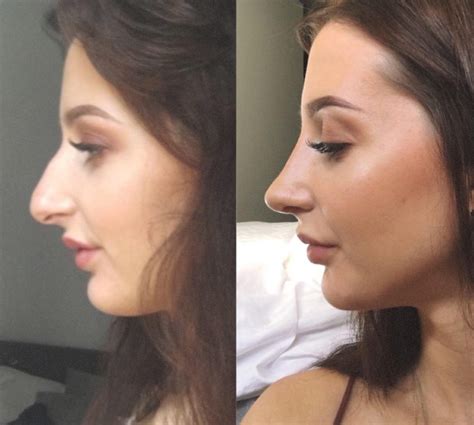 Incredible Rhinoplasty Results Cosmeditour
