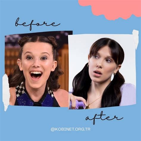 Did Millie Bobby Brown Get Plastic Surgery