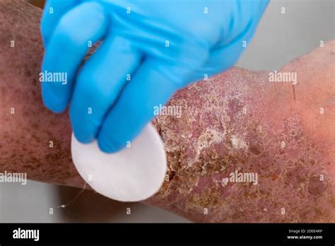 Close Up Picture Of An Infected Wound On Foot Stock Photo Alamy