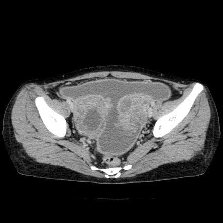 Tuberculous Tubo Ovarian Abscess And Peritonitis Radiology Case