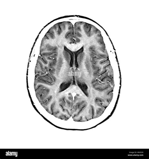 Brain Mri Normal Healthy Stock Photos And Brain Mri Normal Healthy Stock