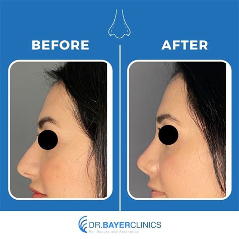 Nose Job Rhinoplasty Before And After Gallery Dr Bayer Clinics