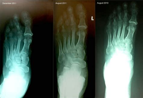 Repeated X Ray Of The Left Foot Primarily Osteolysis Of The Proximal