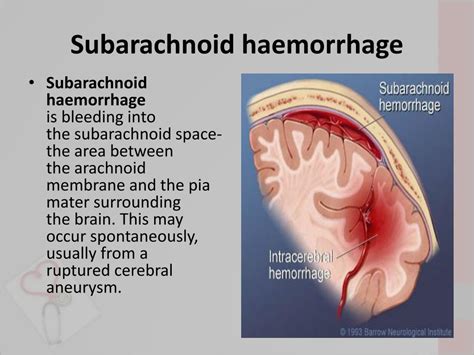 Subarachnoid Hemorrhage D