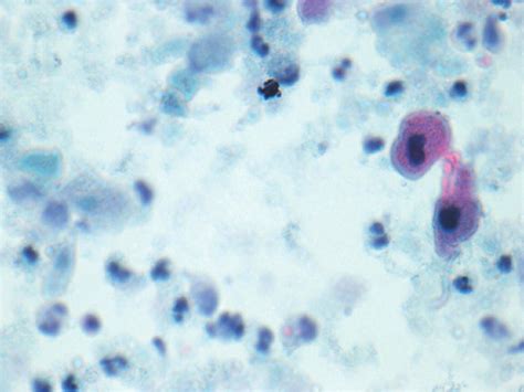 Ascitic Fluid With A Malignant Squamous Cell Component From A Mature