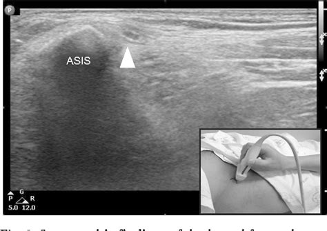 Figure 2 From Ultrasound Guided Lateral Femoral Cutaneous Nerve