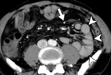 Incidentally Diagnosed Left Paraduodenal Hernia In A 54 Year Old Man