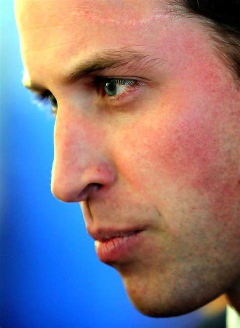 The Unknown Story Behind Kate Middletons Scar Prince William And