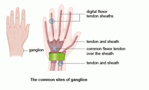 Ganglion Cysts Treatment Removal In Singapore Singapore Sports And Orthopaedic Clinic