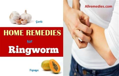 25 Natural Home Remedies For Ringworm In Humans