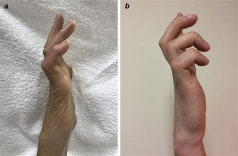 Ulnar Claw A Kinder Gentler Solution Journal Of Hand Therapy