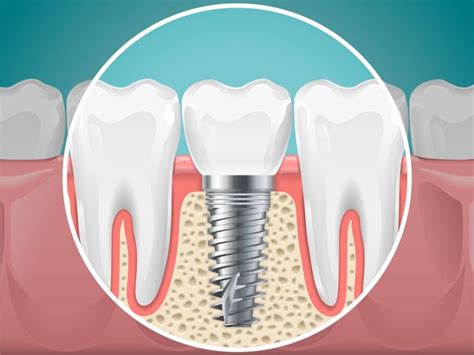 Tooth Replacement Option Dental Implants Can Restore Your Smile