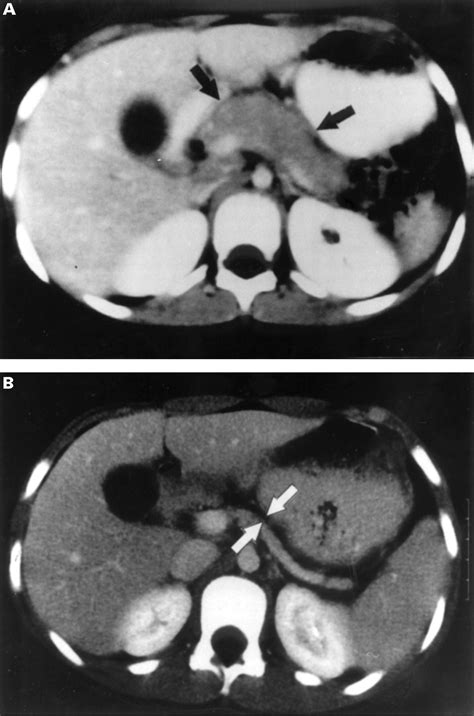 Management Of Fibrosing Pancreatitis In Children Presenting With