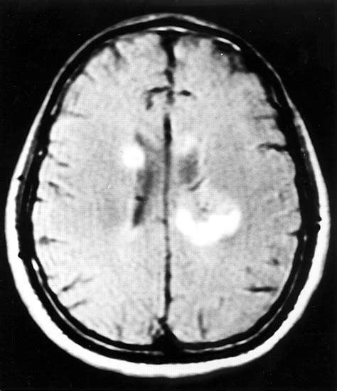 Acute Multifocal Cerebral White Matter Lesions During Transfer Factor