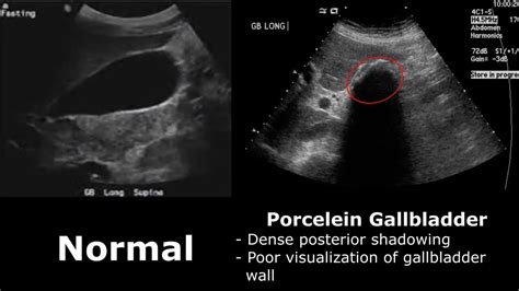 Gallbladder Ultrasound Normal Vs Abnormal Image Appearances Comparison