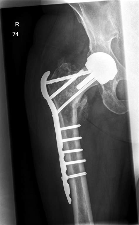 Bilateral Fixation Of A Periprosthetic Intertrochanteric Hip Fracture