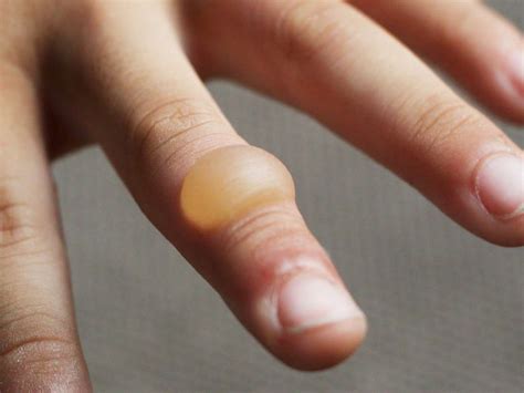 Water Blisters On Fingers Water Ionizer