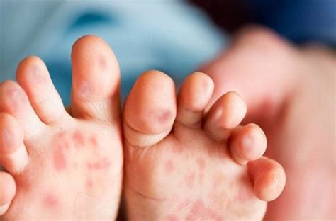 How To Spot Series Hand Foot And Mouth Disease Rahet Bally Your
