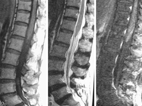 Mr Imaging Findings In Cauda Equina Gnathostomiasis American Journal