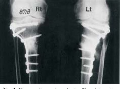 Figure From Bilateral Proximal Tibial Stress Fractures In My XXX Hot Girl