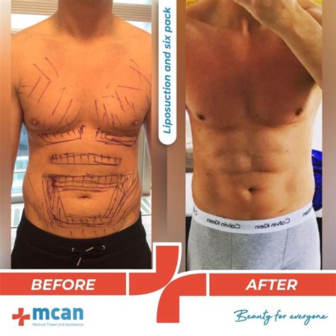 Plastic Surgery Treatment Before And After Mcan Health