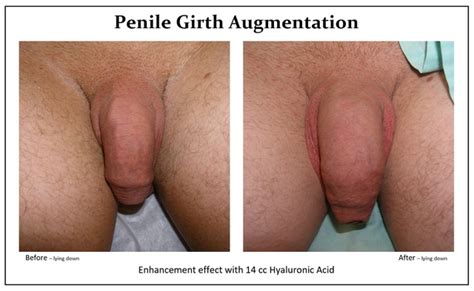 Penis Enlargement Penile Augmentation Increase Penis Size Penile Girth