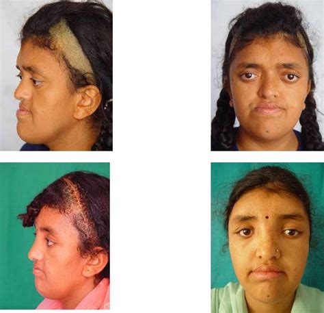 Complex Facial Deformities Inga Health Foundation