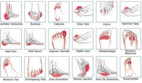 Foot Pain All You Need To Know Causes Treatments Symptoms